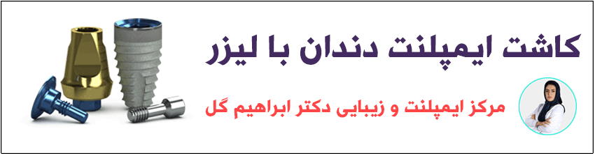 کامپوزیت ونیر چیست؟